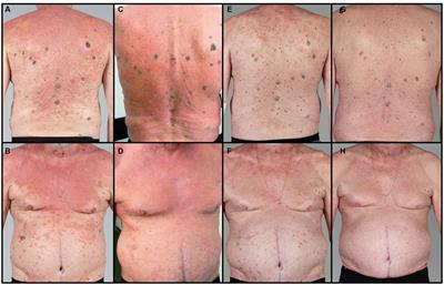 Case report: Area of focus of management of severe pityriasis rubra pilaris by dose optimization of adalimumab biosimilar in combination with acitretin and montelukast